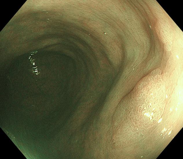 内镜黏膜下肿瘤剥离术,胃镜粘膜下肿瘤剥离术