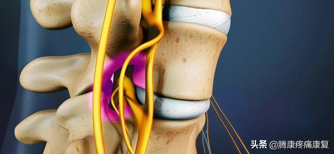 椎管狭窄走路腿疼怎么回事,腰椎管狭窄引起的腿疼