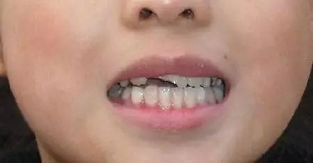 孩子牙缝大什么时候矫正,五岁孩子的牙怎么牙缝越来越大了