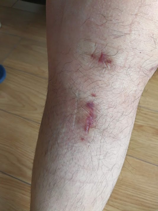 瑞典墨尼克疤痕贴,瑞典墨尼克敷料