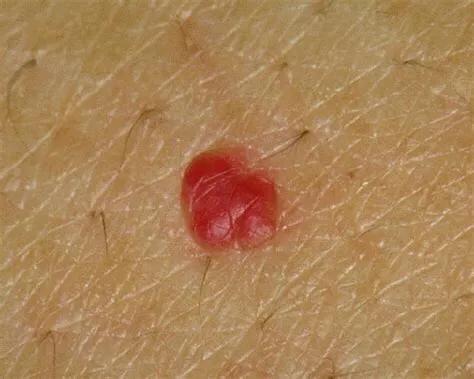 得了乙肝的人身上长红点怎么回事,乙肝病毒携带者身上有一颗颗红点