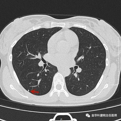 叶建明谈胸膜下的实性结节,叶建明肺实性良性结节会变癌症吗