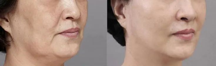 掉头发觉得很丑,掉头发怎么样看起来不像掉发