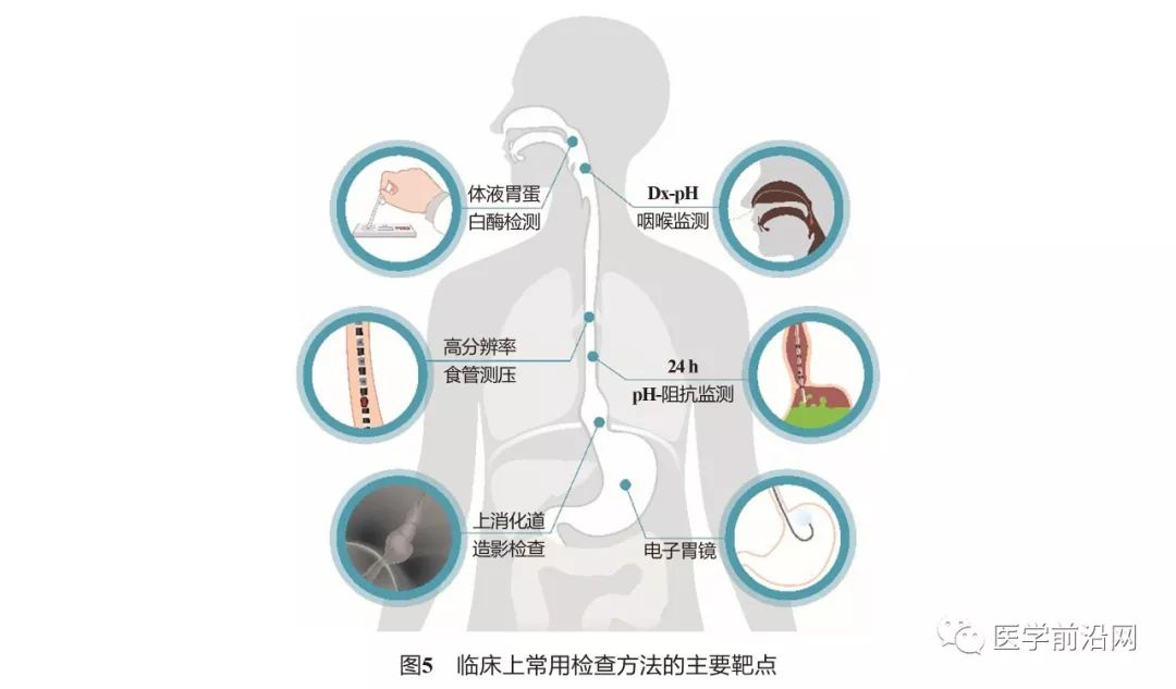 胃食管反流引起的哮喘咳嗽严重吗,胃食管反流性咽喉炎及反流性哮喘