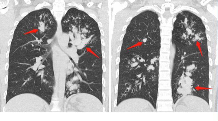 吃发霉馒头是真菌感染吗,水果发霉的霉菌传染吗