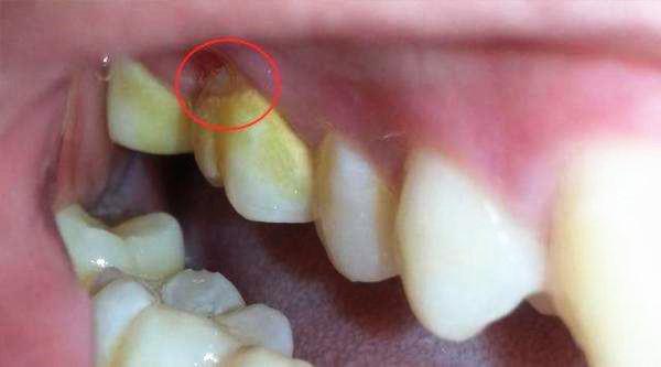 牙齿表面软软发臭的“黄泥”究竟是什么？教你三招，轻松去除
