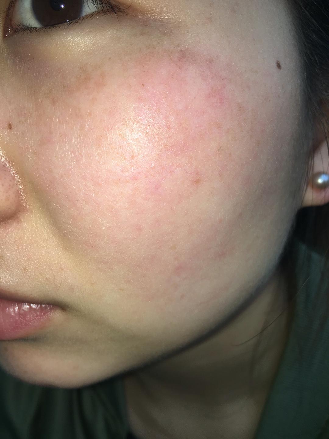 为什么脸上会有细小的血丝出现,为啥有的人脸部有红血丝呢