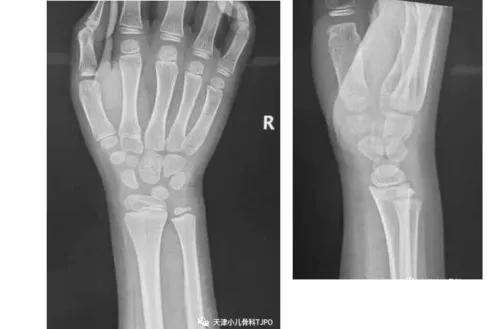 小孩手摔骨折打石膏后可以动吗,摔倒脚骨折需要打石膏吗