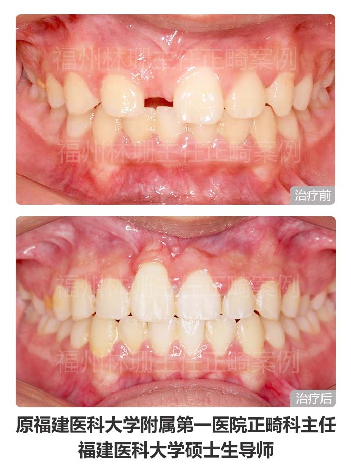牙齿矫正仍然没整齐,异位正常牙齿矫正不过来怎么办