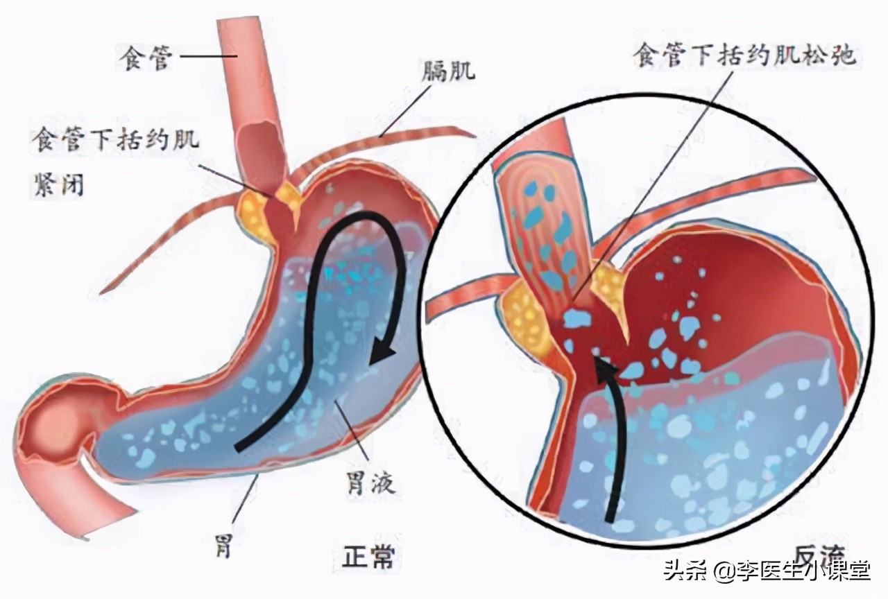 慢性浅表性胃炎伴糜烂反复发作,浅表性胃炎有三十年老反复发作