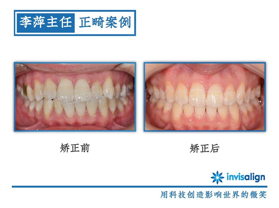 深覆合牙齿不齐矫正案例,29岁牙齿矫正龅牙前突案例