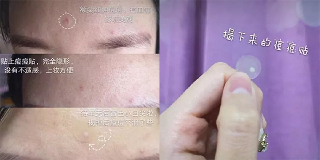有效祛痘印的痘痘贴,祛痘痘的药膏明星