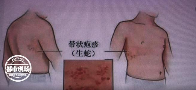 每年夏天左脚长水泡怎么回事,左腿突然长几个水泡怎么治疗