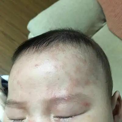 夏季宝宝湿疹高发，爸妈学会这几招，轻松应对宝宝湿疹