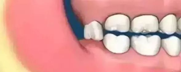 口腔智齿,智齿拔除后怎么处理智齿