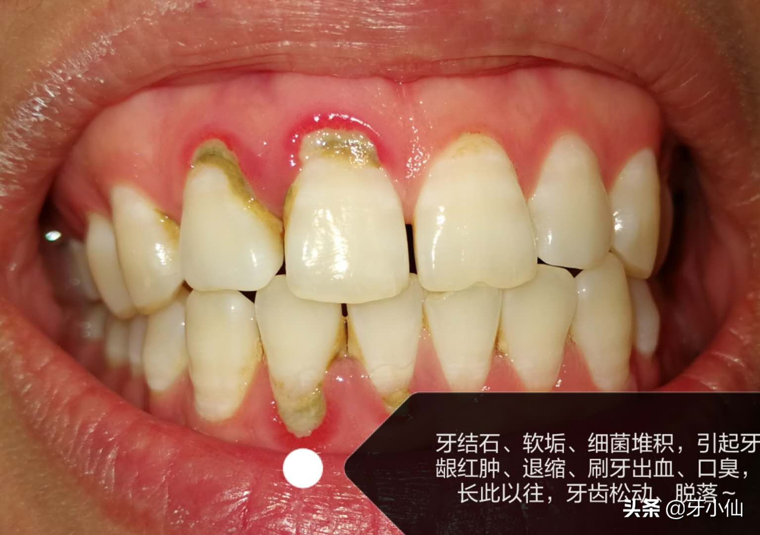 牙龈出血口臭跟牙齿不贴合,有个牙齿晃动牙龈出血口臭