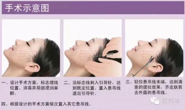 什么是线雕图片,什么是线雕线雕效果怎么样