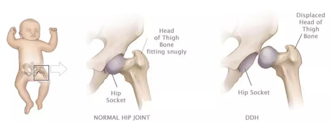 孩子腿型发展不好,小孩腿型发育