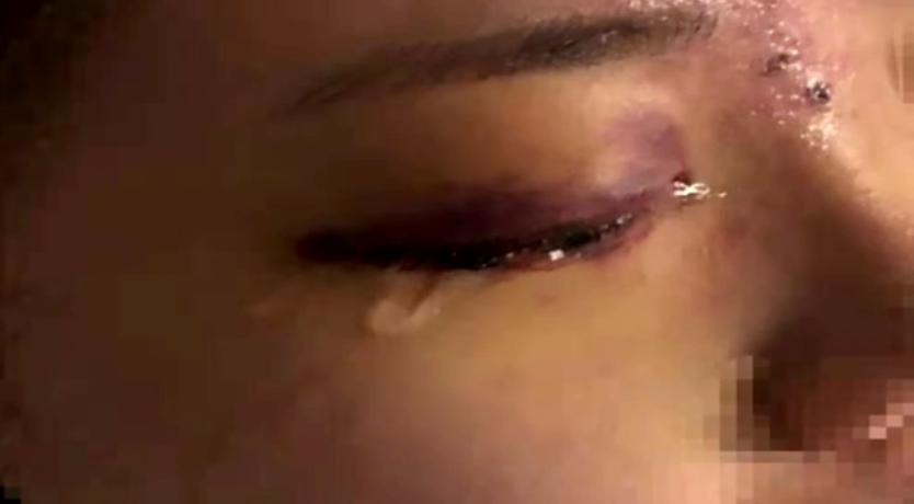 整形眼睛失明怎么办,为什么做眼睛整形会失明