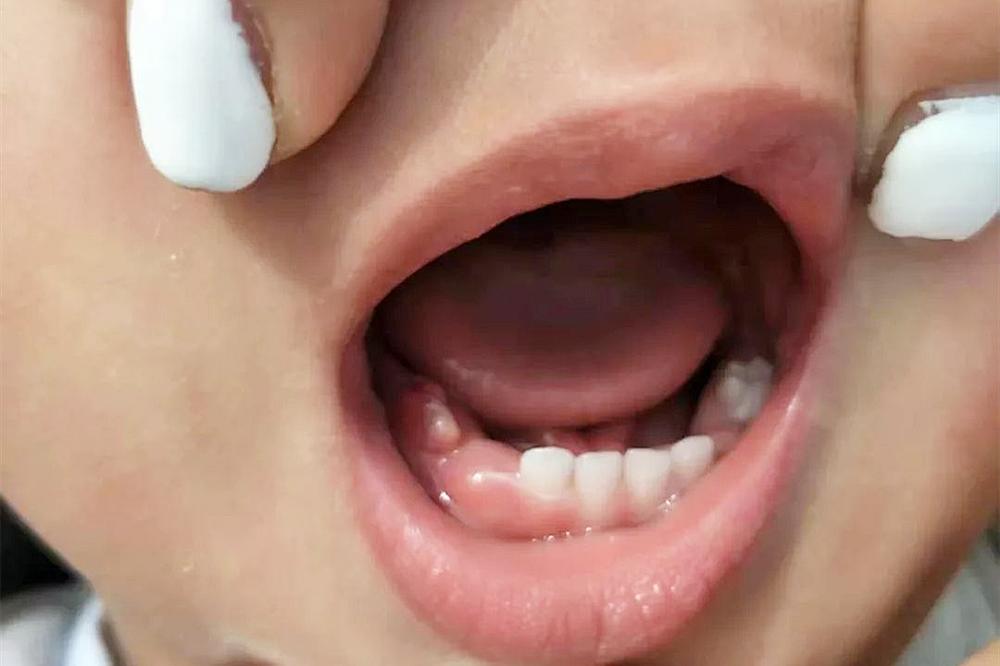 宝宝长牙顺序和注意事项,宝宝长牙顺序及征兆处理方法