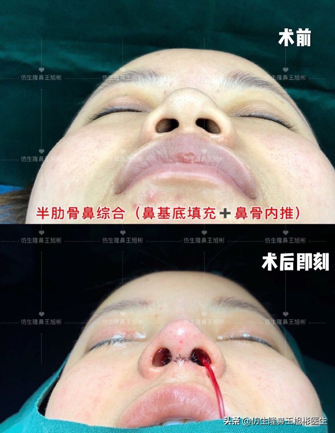 鼻头部位整形,鼻头圆钝高鼻梁整形案例