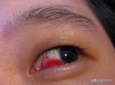 美瞳线麻药灼伤眼睛处理方法,美瞳线过后红肿怎么处理