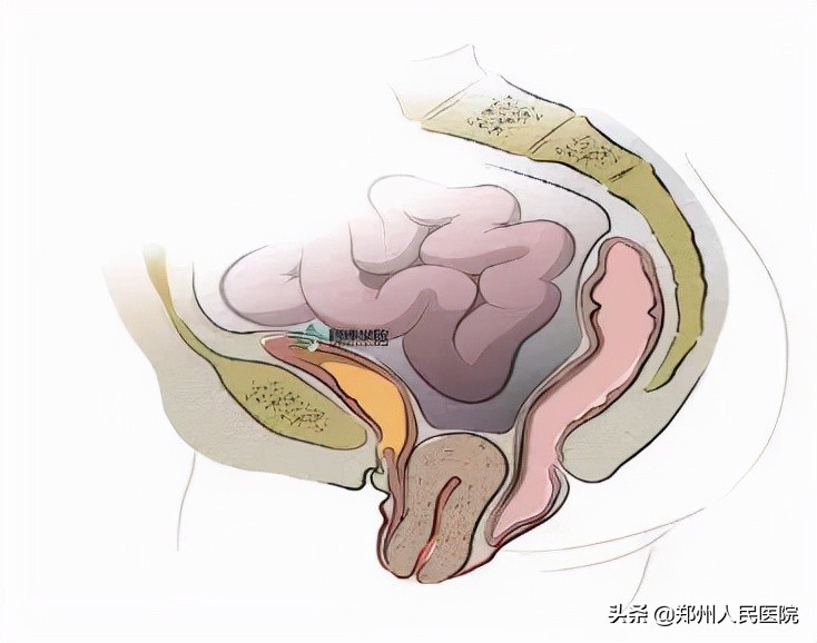 子宫切除又有东西脱落是啥,子宫切除后发现有个蛋状的东西