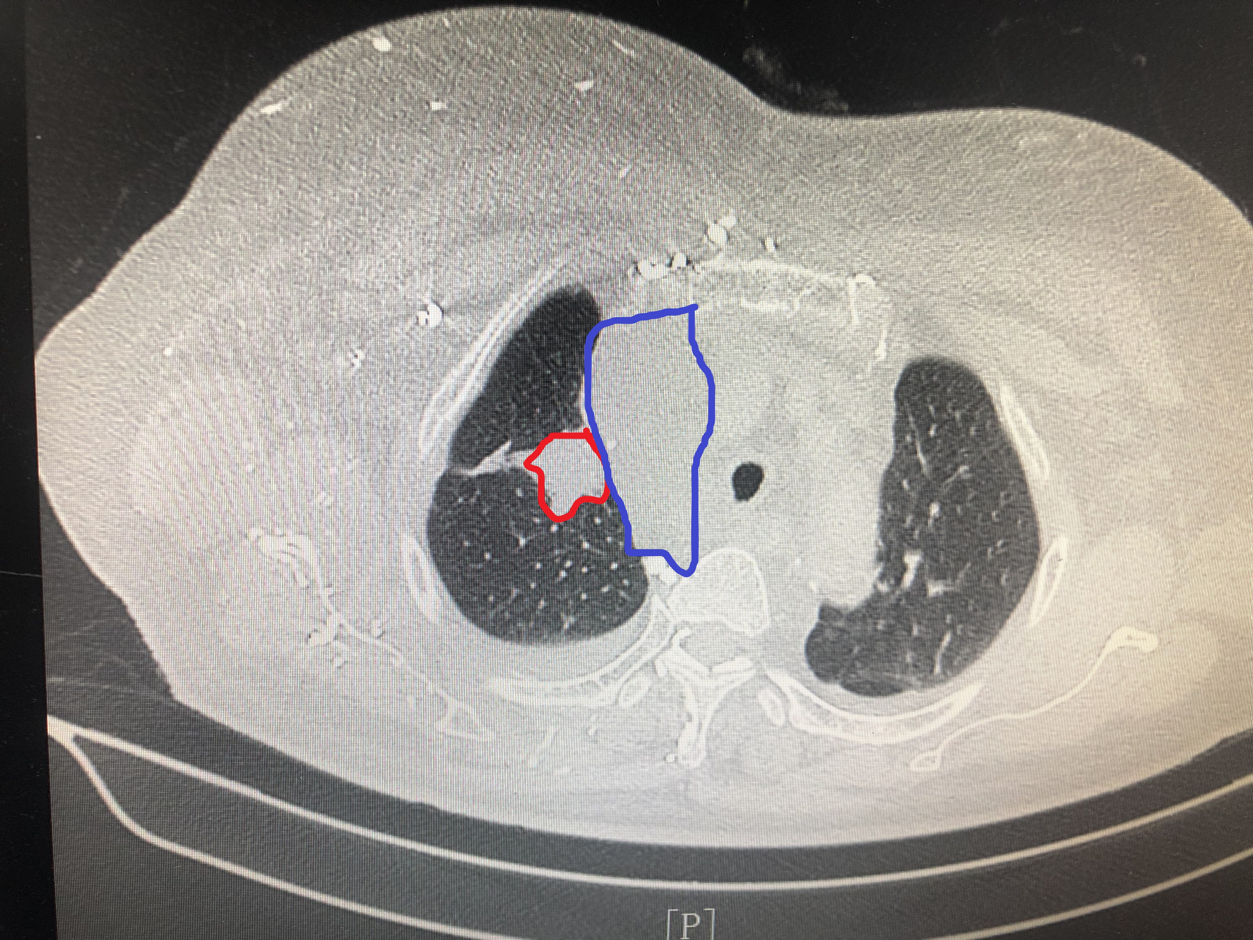 怎样判断非小细胞肺癌早中晚期,做气管镜能查出肺癌早中晚期吗