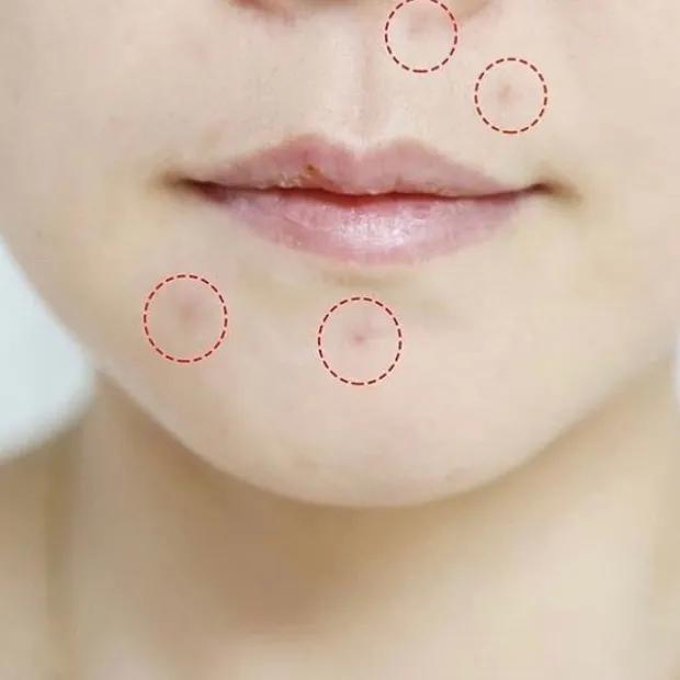 十年战痘肌自救指南,十年痘肌怎么抗痘