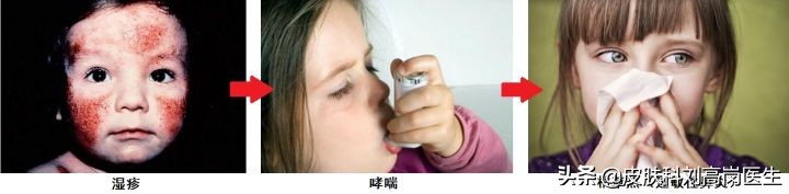 儿童常见皮肤病湿疹,红皮湿疹治疗方法