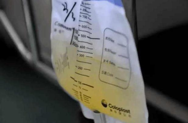 剖腹产之后插尿管的步骤,剖腹产拔了尿管怎么快速排尿