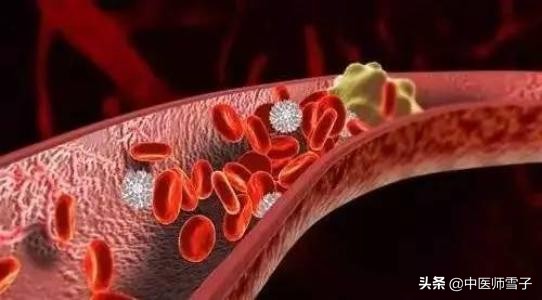 刮痧艾灸拔罐治富贵包,针灸拔罐艾灸能一块做吗