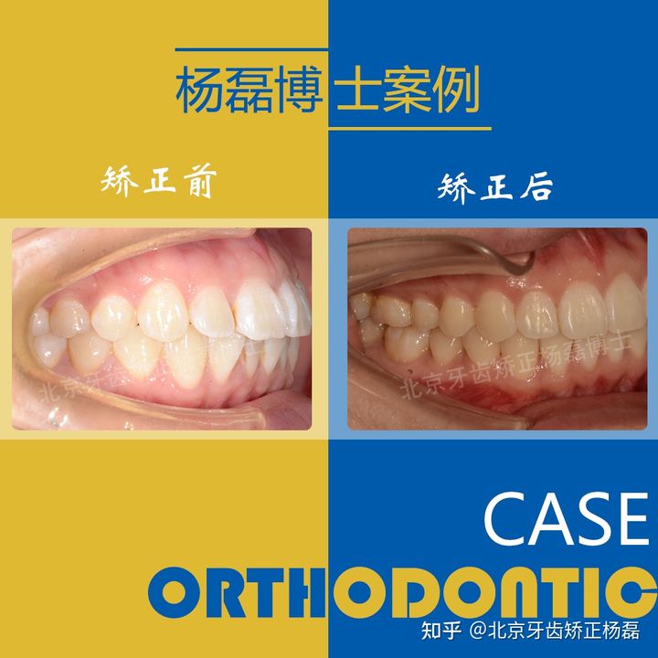 北京牙齿深覆合矫正推荐,重度拥挤牙齿矫正案例不拔牙