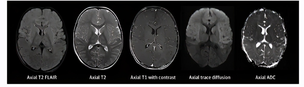 脑科学日报：干细胞移植是治疗脑创伤的新希望？