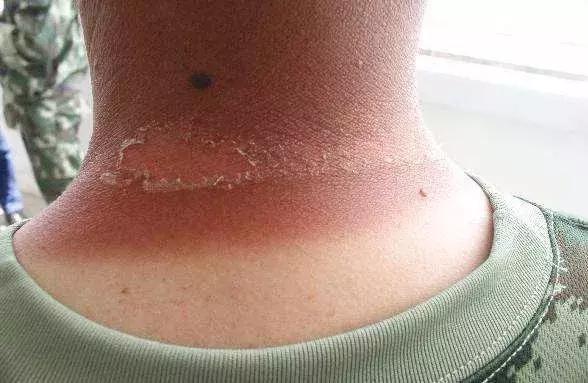 军训后要被晒成碳？史上最强晒后修复攻略，让你快速白回来