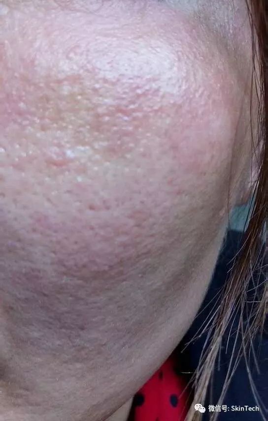 逆光疹是属于皮肤炎症吗,逆光疹是不是日光性皮炎