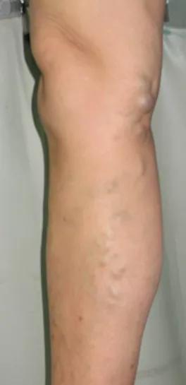 腿上长蚯蚓有哪些东西要戒掉,腿上有小蚯蚓怎么办