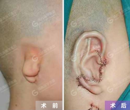 余文林博士耳朵畸形,余文林小耳畸形再造