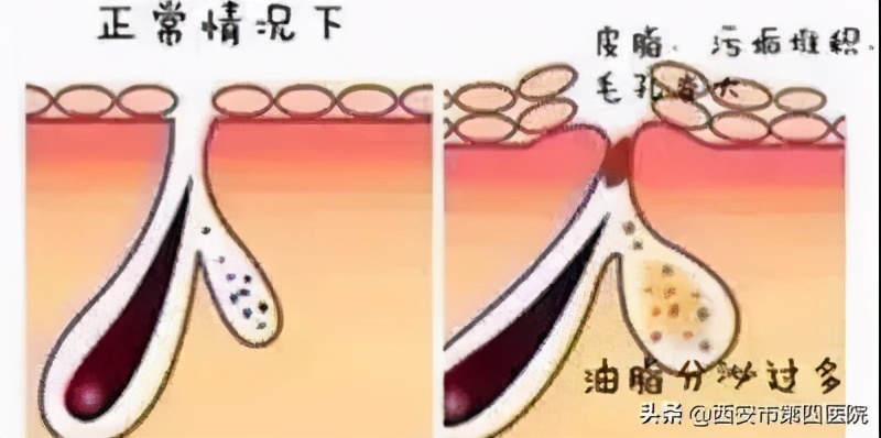 毛孔粗大的正确护肤方法,毛孔粗大正确护肤方法