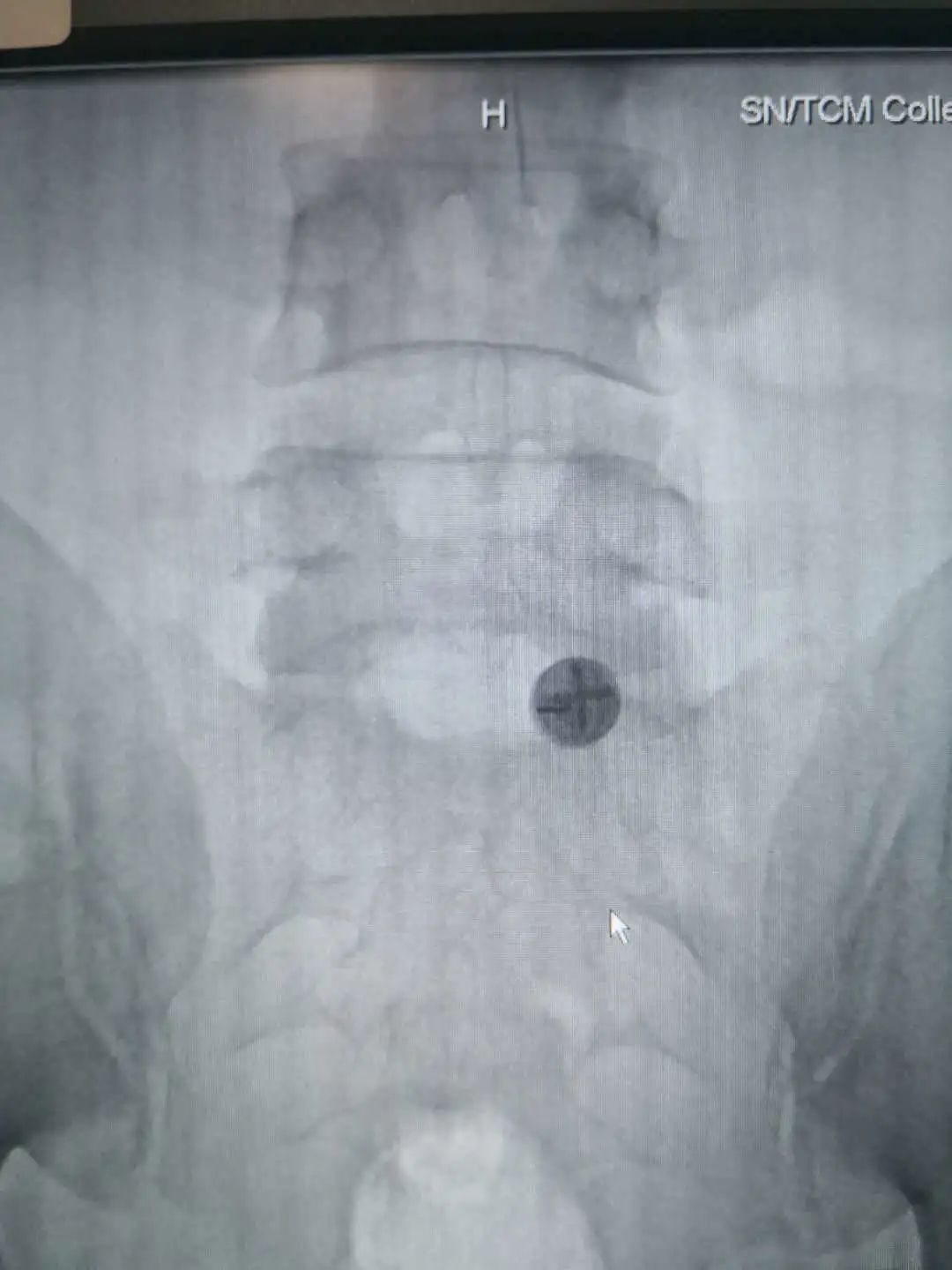 陕西椎间孔镜手术最好的医院,椎间孔镜手术陕西哪个医院做得好
