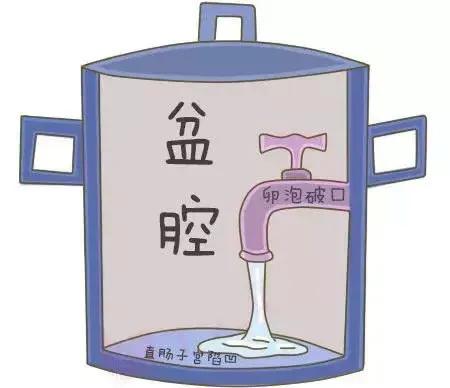 体检查出盆腔积液，听说还影响生育，这真是一肚子“坏水”？