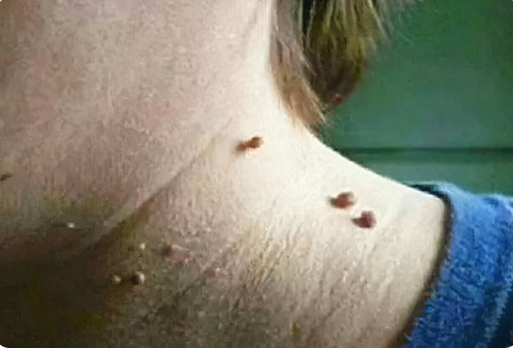 腋下脖子上长小肉粒去除方法,脖子上有小肉粒会传染给其他人吗