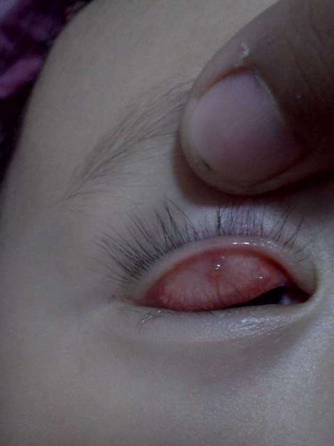 眼睛皮里面长了一个包,眼睛长包会导致视力变弱吗