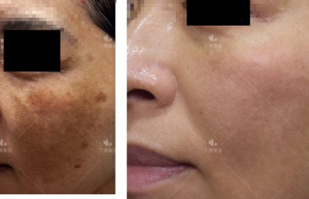 铅汞脸如何自救,那些被毁容的女孩