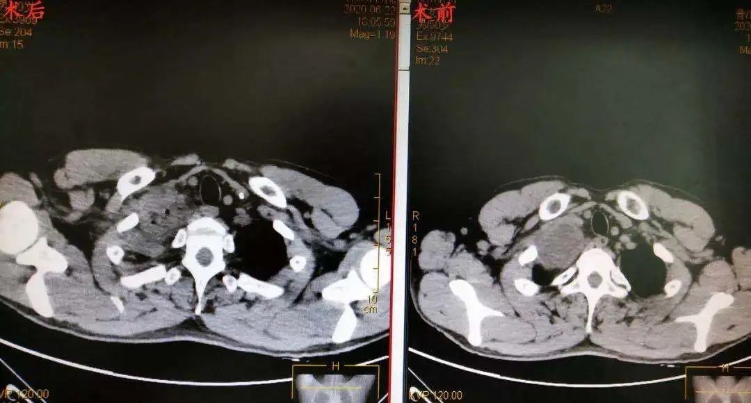 26岁小伙子查出恶性肿瘤,27岁小伙突然发现恶性肿瘤