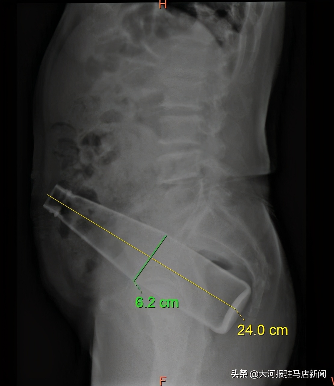难以启齿的病后续,难以启齿的就医后续