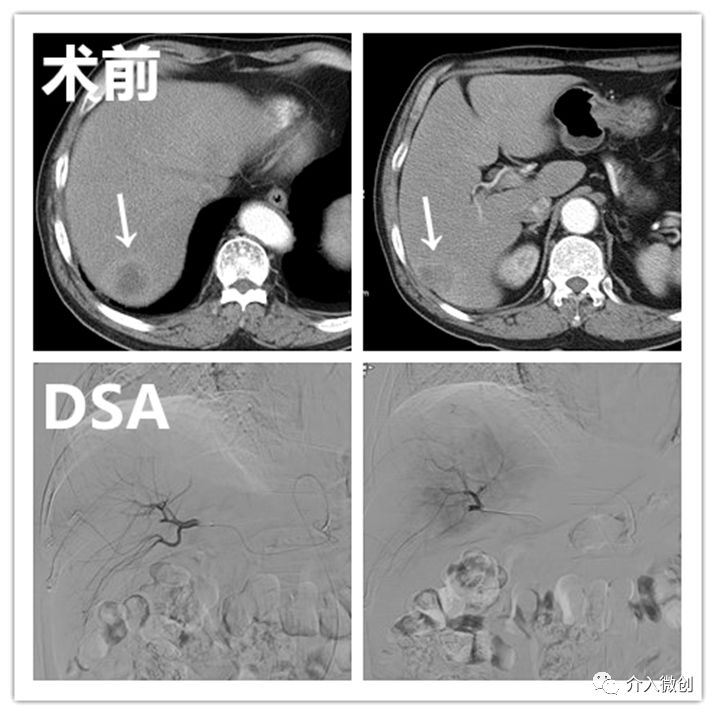 栓塞介入能治疗肝转移瘤吗,结肠癌肝转移介入栓塞治疗