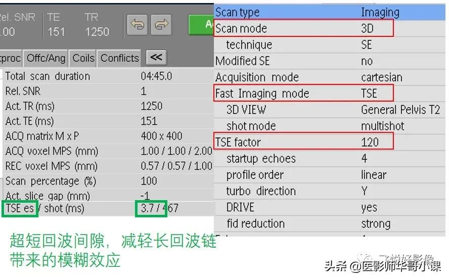 [飞利浦磁共振技术]磁共振扫描下的“女性输卵管成像”，看视频吧