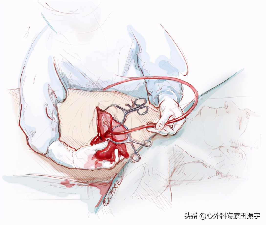 急性B型主动脉夹层合并主动脉破裂的急诊处理