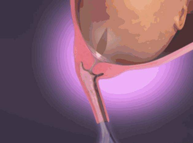 顺产生孩子剖腹产的真实流程,顺产剖腹产生孩子的真实流程